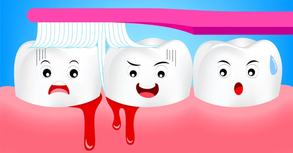 Is Bleeding Gums an Early Sign of Gum Disease Basildon?