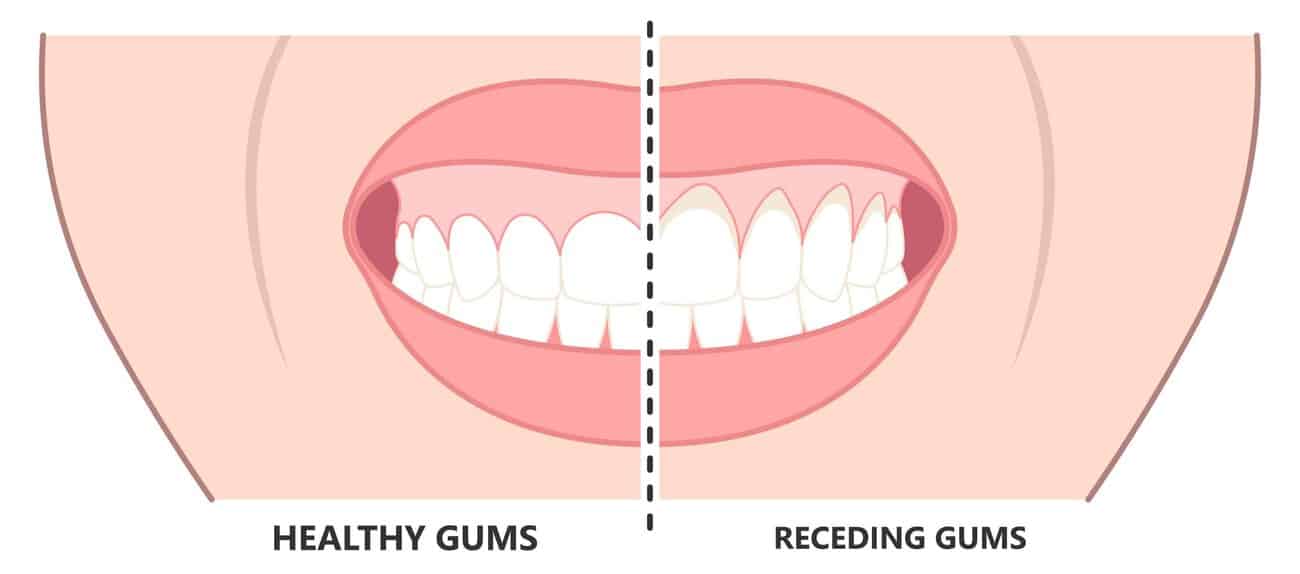 What Causes Gums to Recede Over Time Basildon